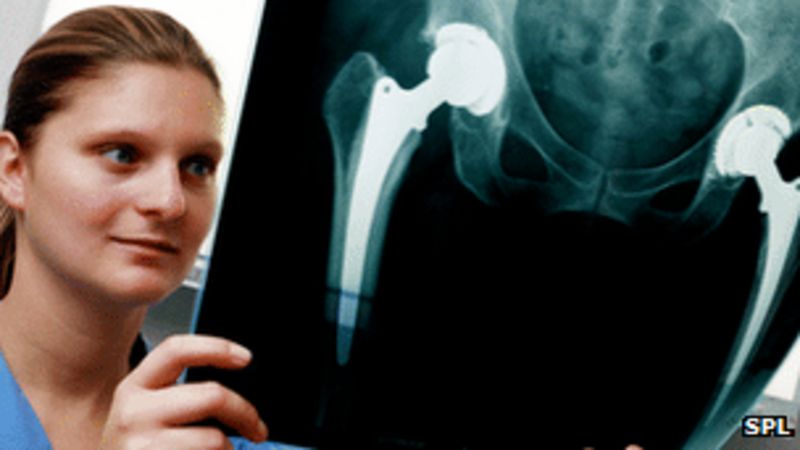 Metal On Metal Hip Replacements High Failure Rate Bbc News