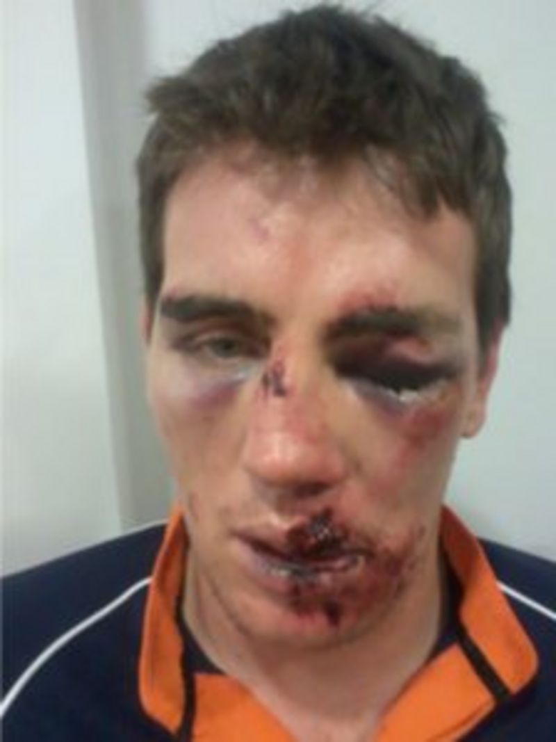 Rugby Player Attacked In Bournemouth Let Down By Police Bbc News