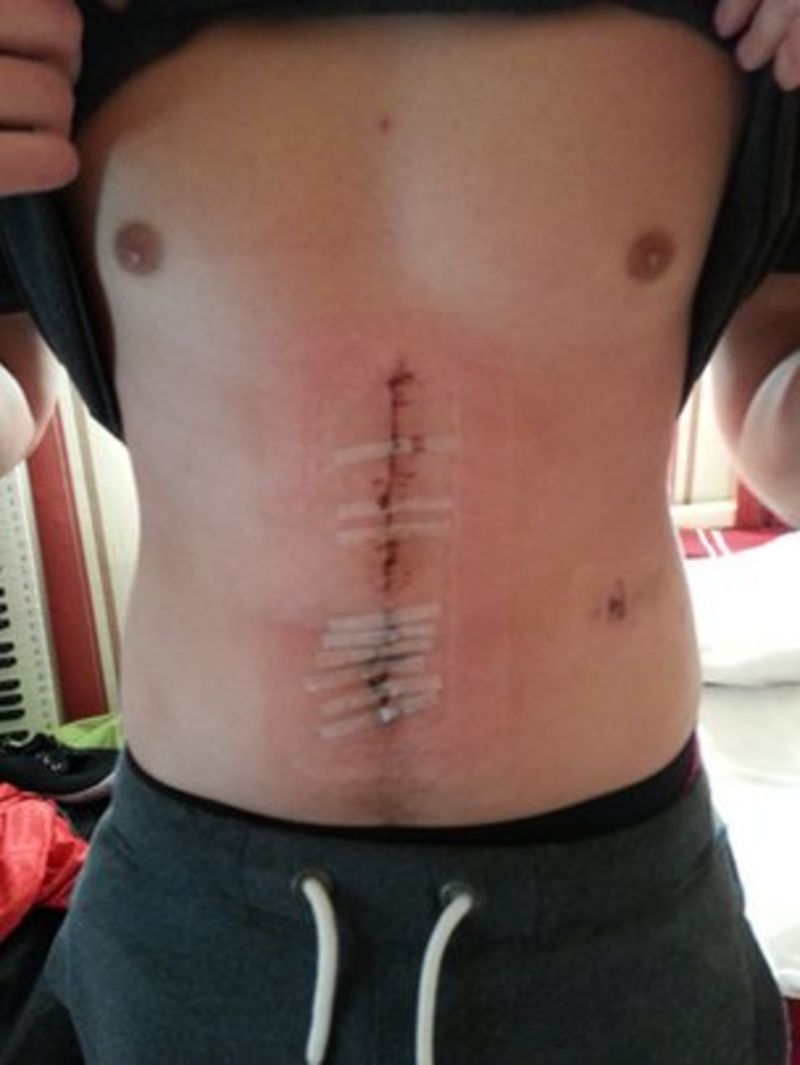 First UK live liver donation to a stranger takes place BBC News