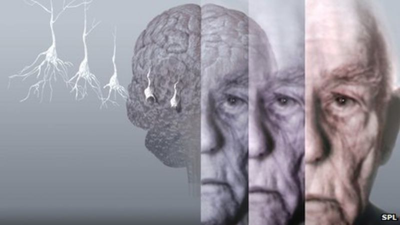 Alzheimer's Breakthrough: Cure Or Hype? - BBC News