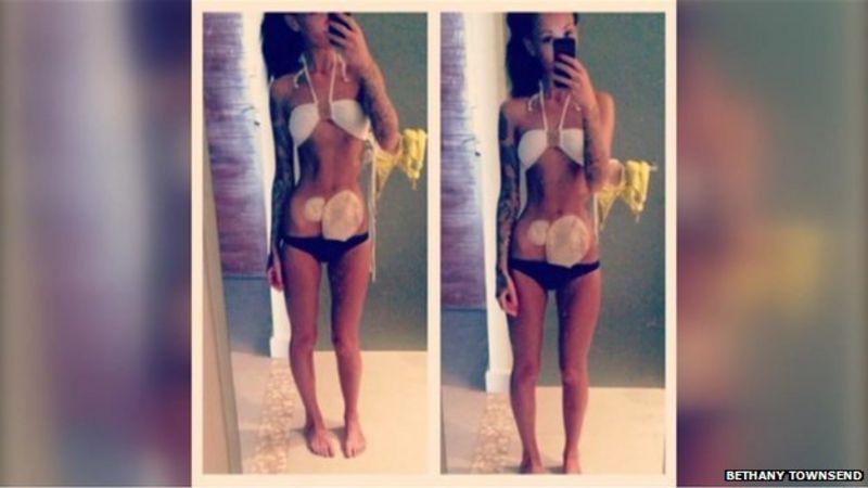 Colostomy Bag Bikini Photograph Seen By Nine Million Bbc News 