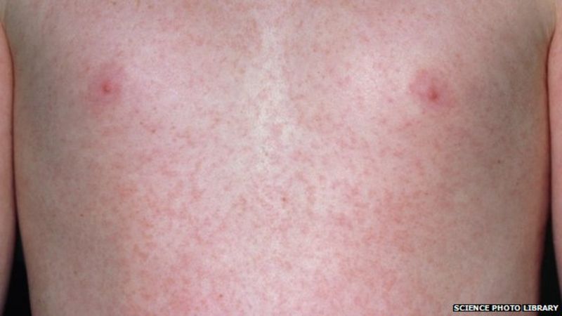Rubella (German measles) eradicated from Americas BBC News Rubella (German measles) eradicated from Americas BBC News