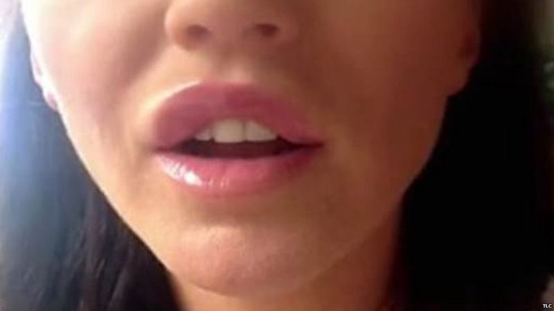 Doctors Call For New Lip Filler Regulations Bbc News