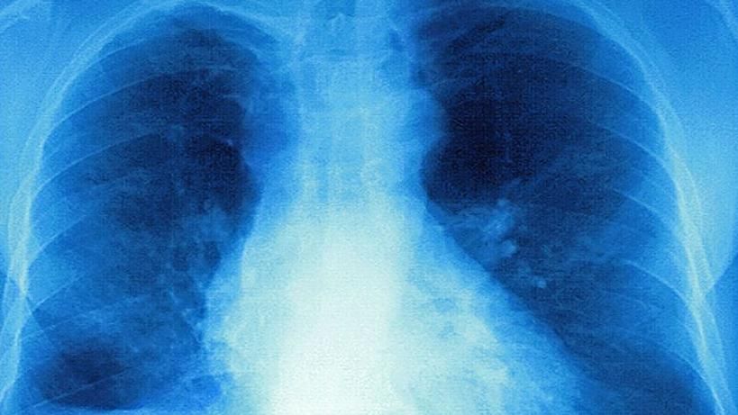 X-ray showing mucus in the lungs