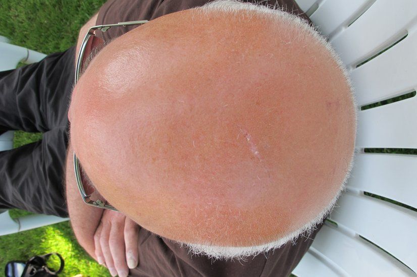 Bald head
