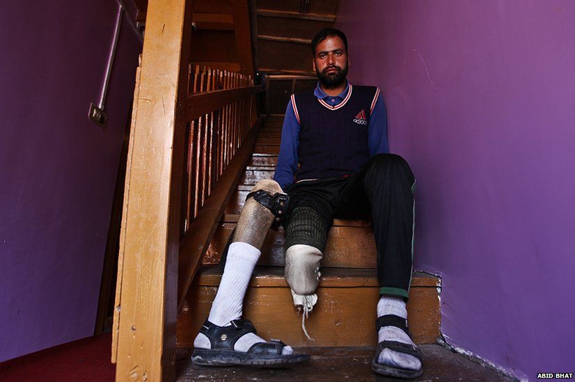 Irshad Ahmad displays his disfigured limb, at his house in Uri. Mr Ahmed was wounded in cross-border shelling on 1 November 2001.