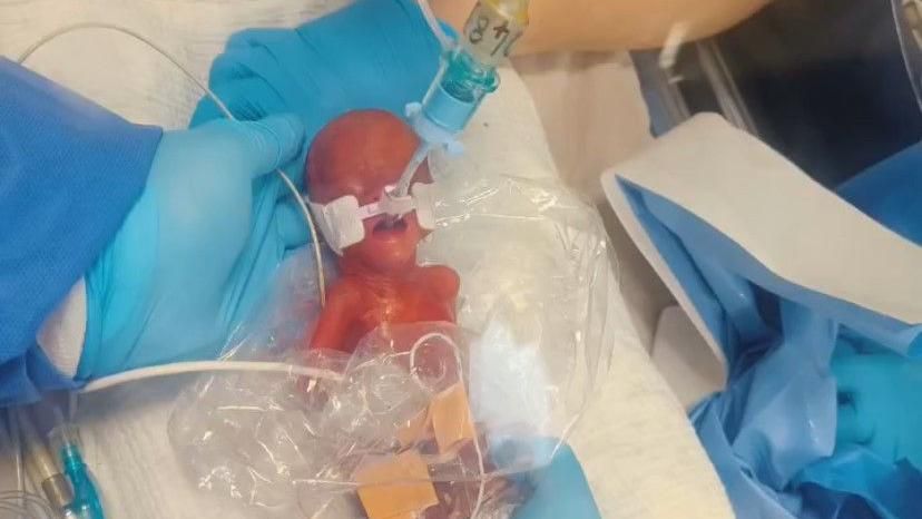 tiny premature baby Robyn in a sandwich bag