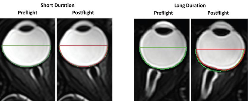 ImÃ¡genes de globos oculares de astronautas en misiones cortas y prolongadas.