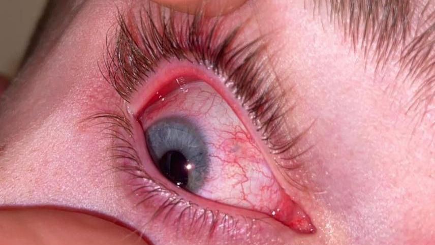 Ryan Taggart's bloodshot eye when it was damaged by the metal. The edge of his finger is holding the eye open to show the metal and the damage. 