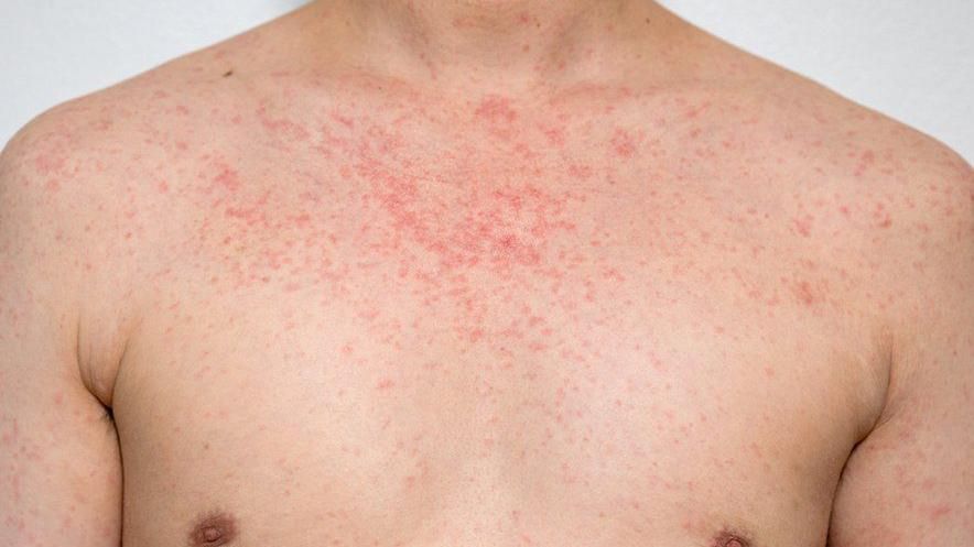 Measles on a body