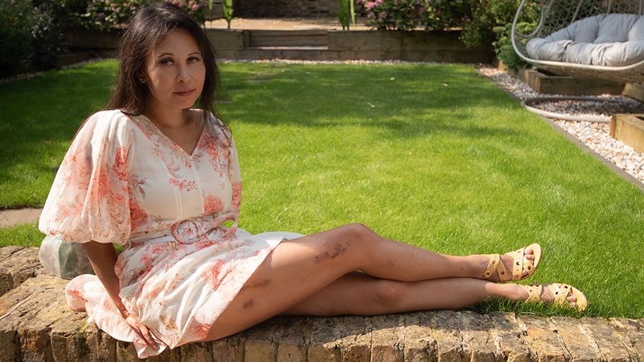 Elaine Foo sitting on a garden wall with her legs still showing bruises from her operation.