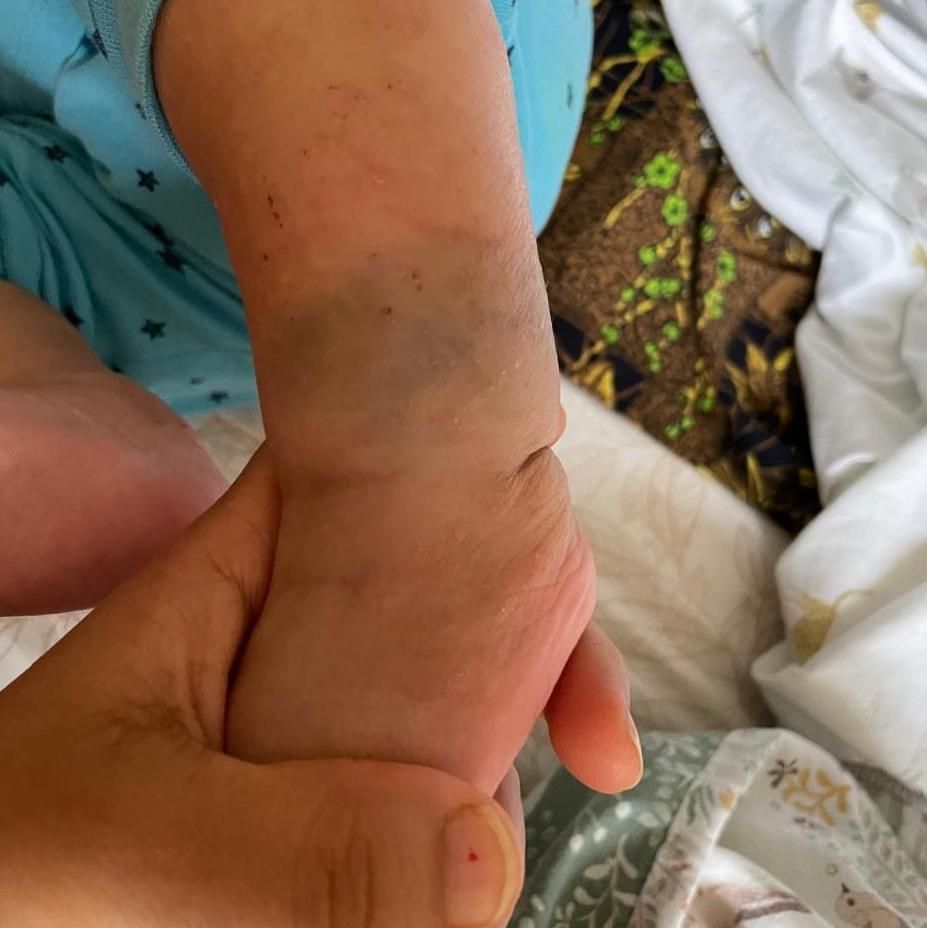 Laxmi Thapa's baby son's leg with blue spot birthmark