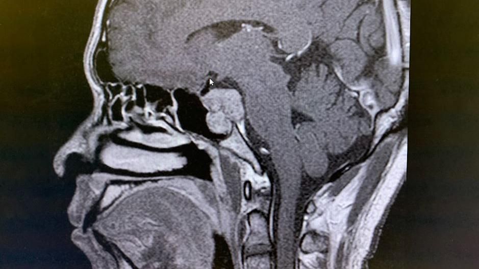 A x-ray image showing the tumour at the base of David's skull