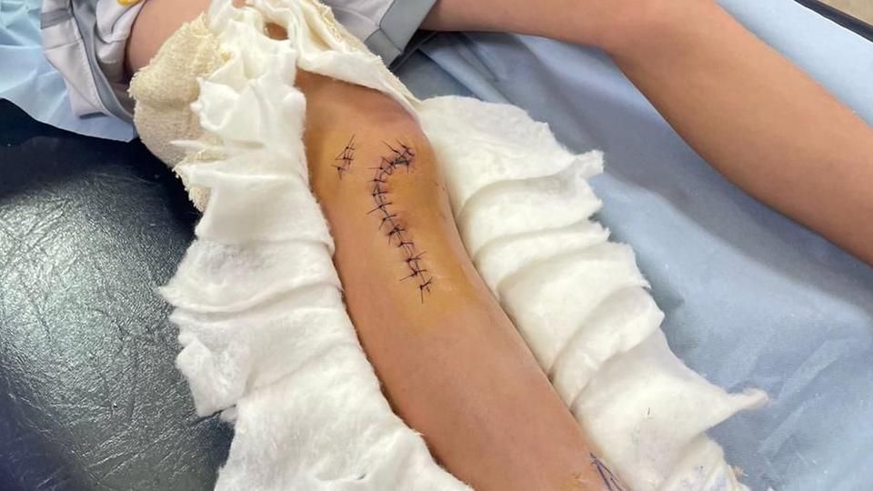 A boys leg with stitches on a hospital bed 