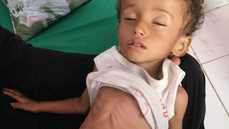If you remember nothing of #Yemen remember Hussein Mazen Hussein - malnourished and fighting for every breath