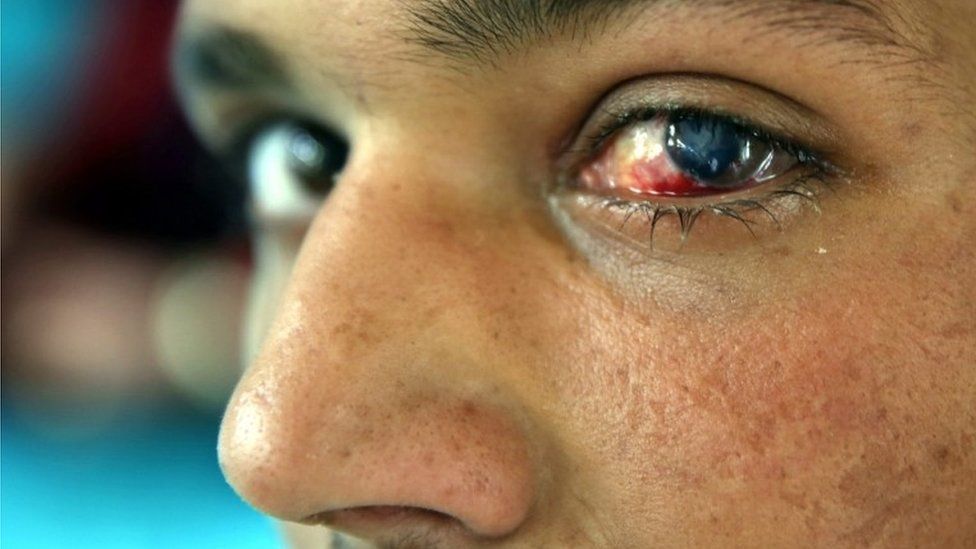 A pellet-injured Kashmiri Muslim boy shows his eyes inside a local hospital in Srinagar, the summer capital of Indian Kashmir, 14 July 2016