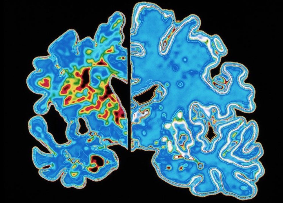 Graphic of an Alzheimer patient (left) compared with a normal brain (right)