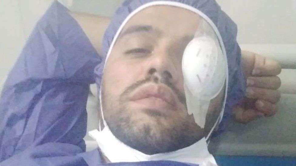 Mohammad Farzi in hospital with his injured eye