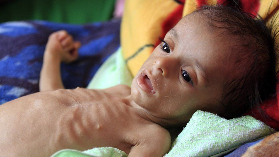 A malnourished Yemeni child receives treatment at a hospital in Sanaa on 22 November 2017