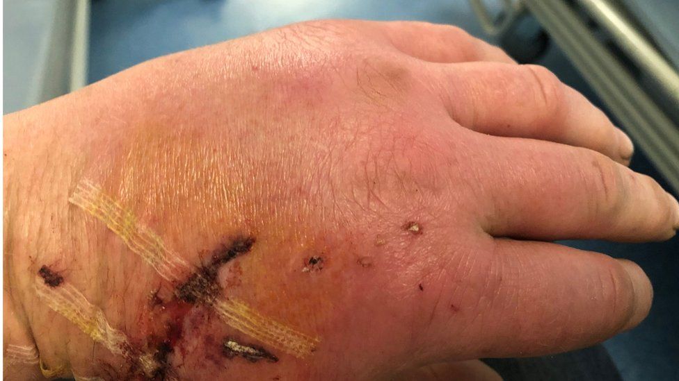 Scars on Darren Davies' hand after he was attacked by a dog