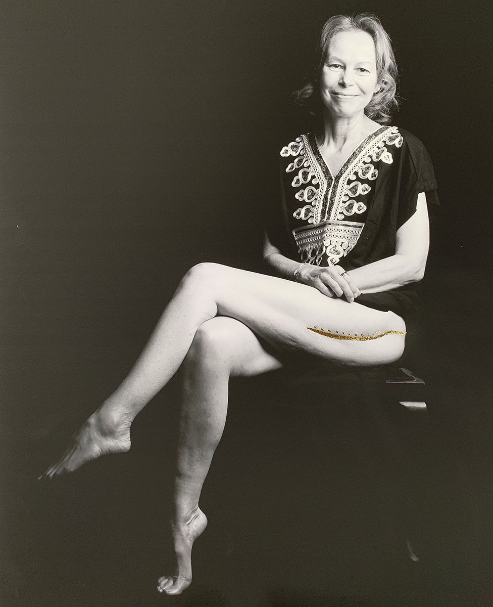 A black and white image of a female patient with a scar on her leg filled in with gold leaf