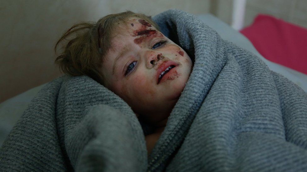 A Syrian child injured in an attack on the town of Misraba, in the Eastern Ghouta outside Damascus, receives treatment at a make-shift hospital in Douma (4 January 2018)