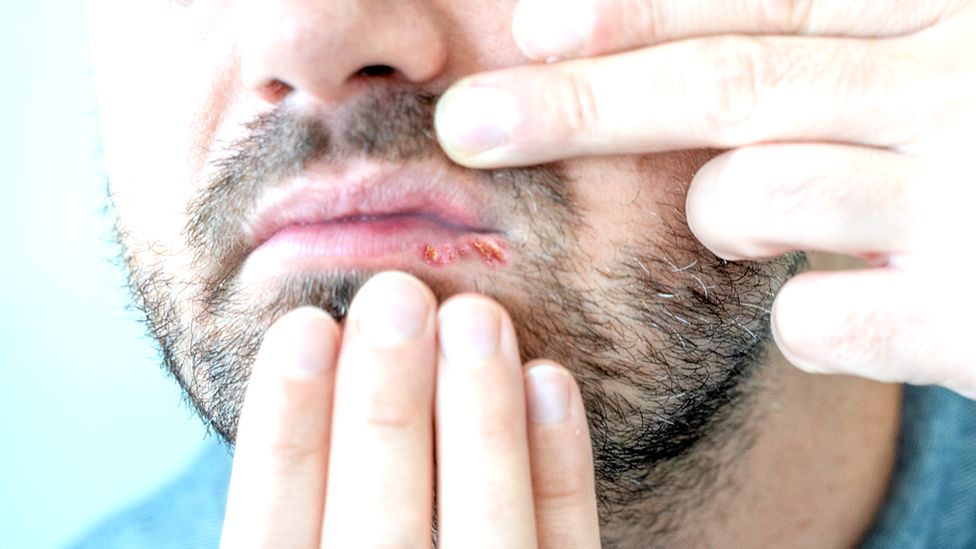 Herpes infection on the lips