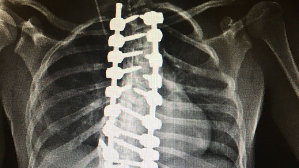 Scoliosis // Middlesex Health