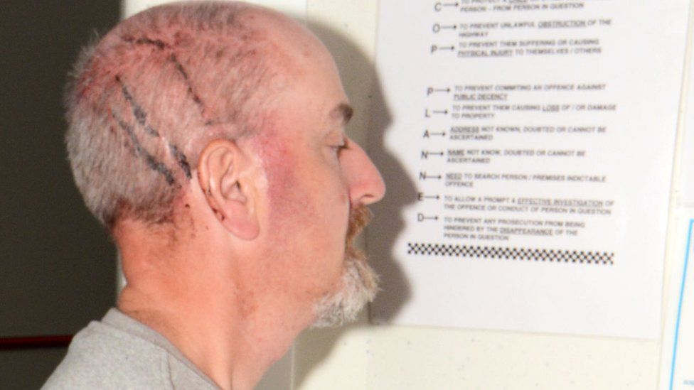 Thomas Mair and his head injuries after he had murdered Jo Cox