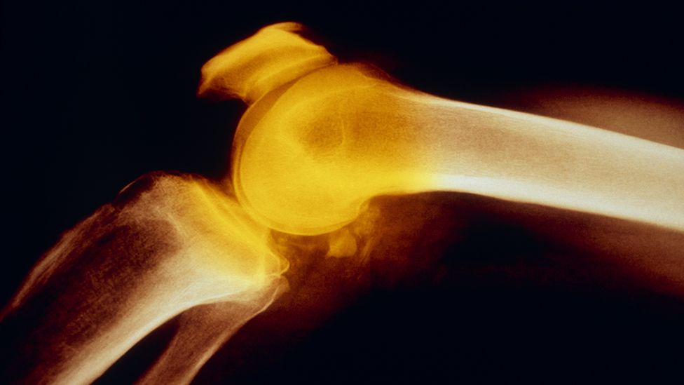 X-ray of an osteoarthric knee