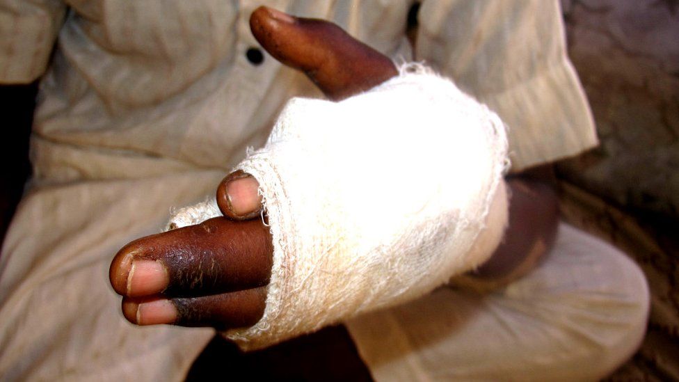 bandage on hand