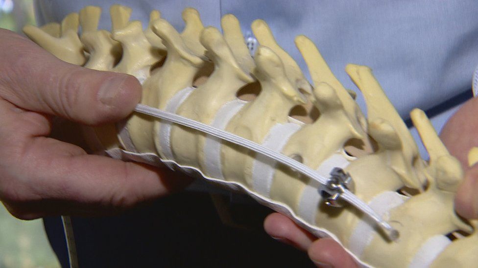 Scottish surgeons want twisted spine operation approval BBC News