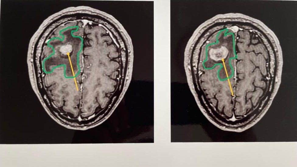 Two scans of Spike's brain, side by side. One shows a larger tumour, before treatment started. The other shows a smaller tumour, after treatment.