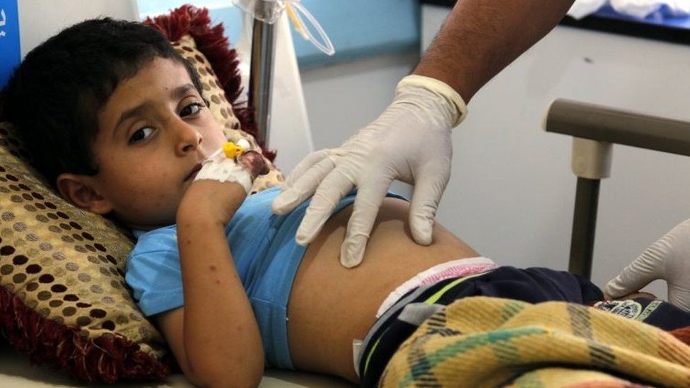 A Yemeni child suspected of being infected with cholera receives treatment at a hospital in Sanaa (15 June 2017)