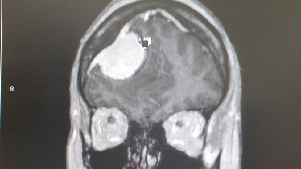 Scan of head showing tumour