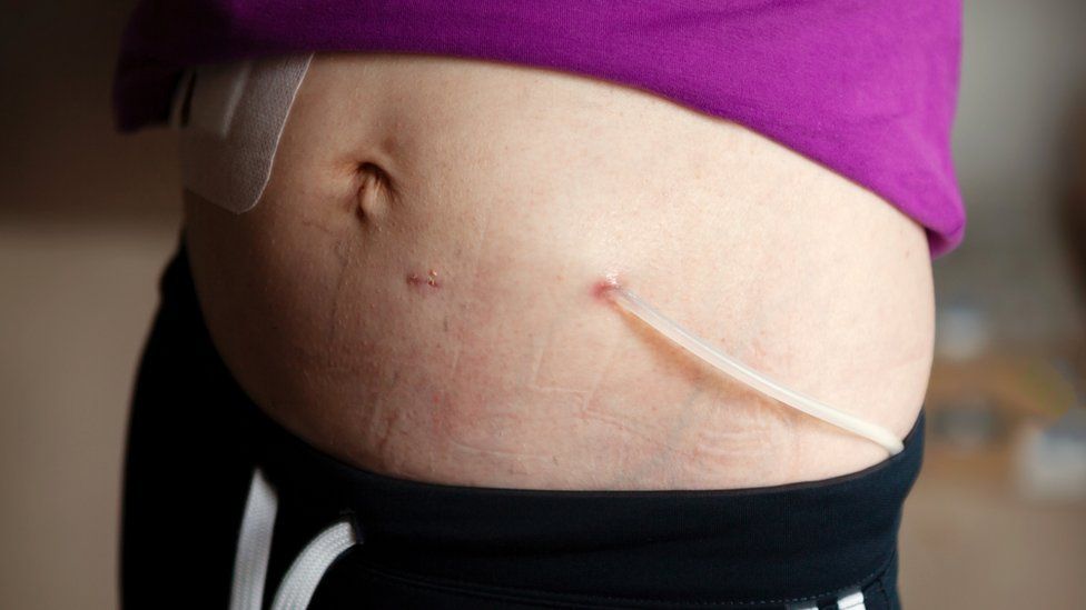 Should organ donors be paid? The heavy toll of US kidney shortage BBC