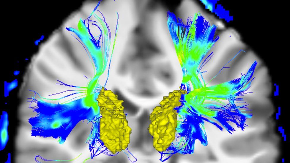 Brain with Parkinson's