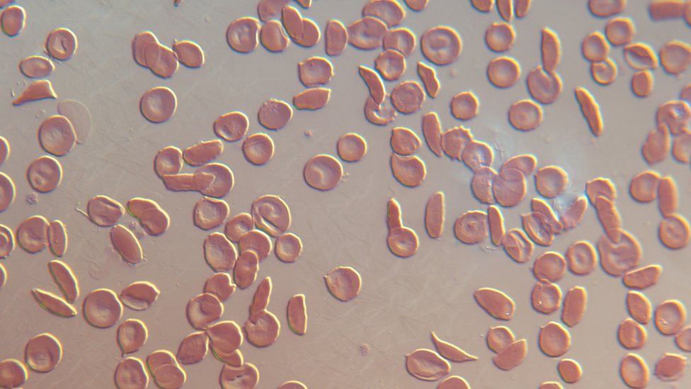 A sickle cell blood smear