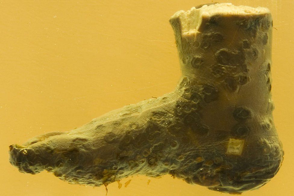 Preserved foot of smallpox sufferer