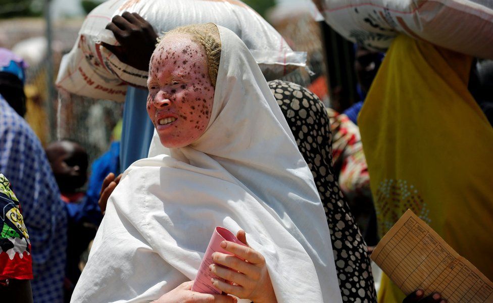 An albino woman waits for food rations at an internally displaced persons camp on the outskirts of Maiduguri, northeast Nigeria June 6, 2017