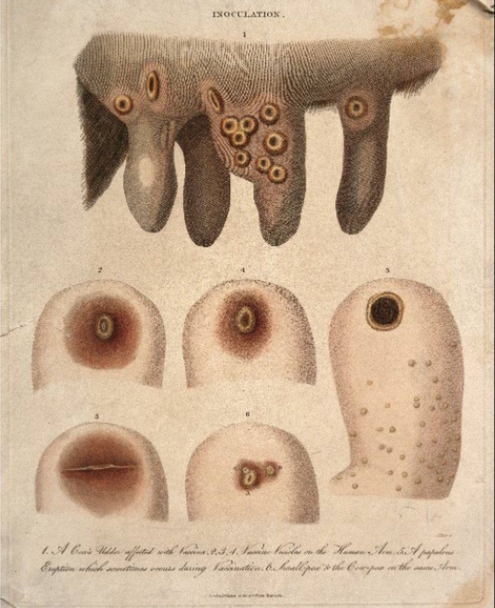 Engraving of a cow's udder with cowpox pustules and human arm showing cowpox and smallpox