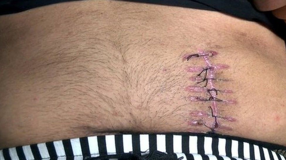 Stitches of man who sold his kidney Archive picture