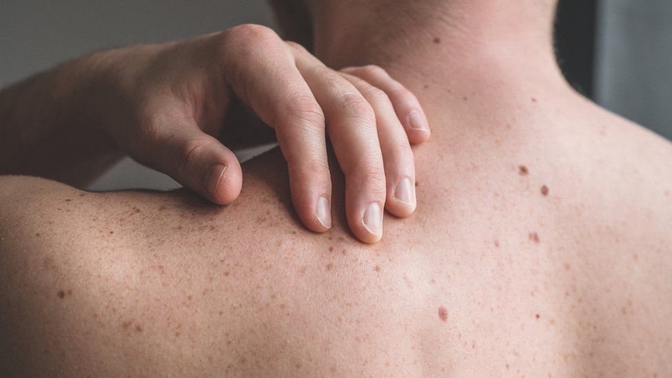 Man checking his back for moles