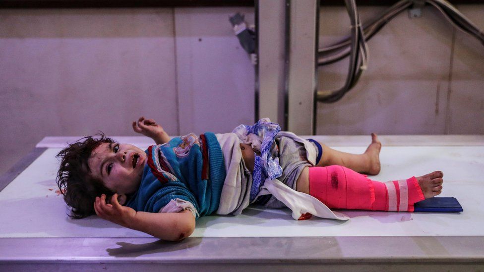 An injured child receives first aid in hospital after a bombing in Douma, eastern Ghouta, Syria, 08 February 2018