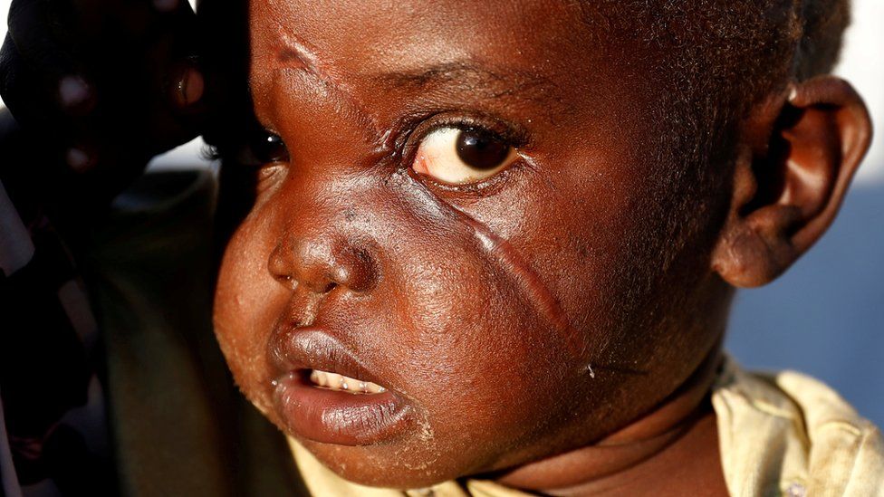 Girl with scar in a camp in Bunia, Ituri province, eastern Democratic Republic of Congo, April 9, 2018.