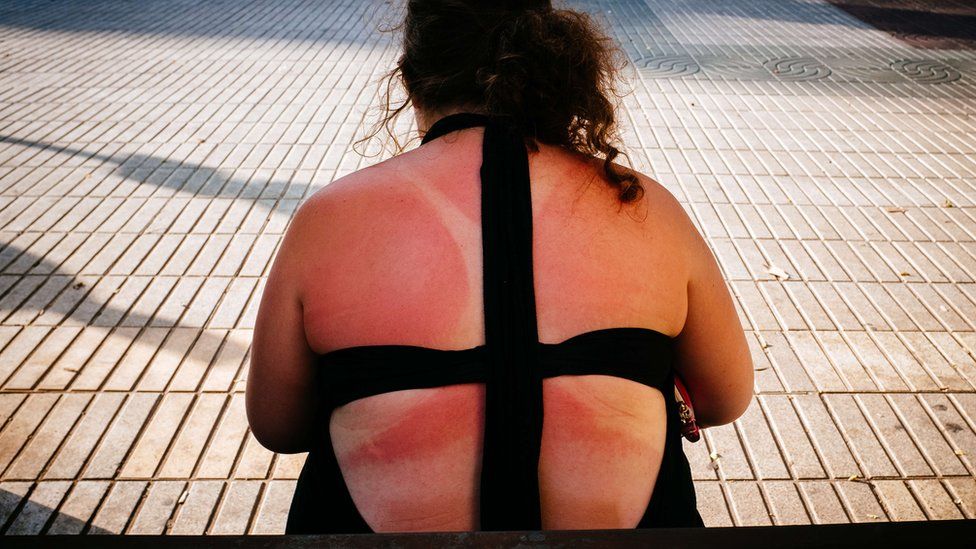 A woman with sunburn