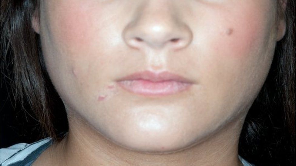 Young woman with swollen glands and mumps