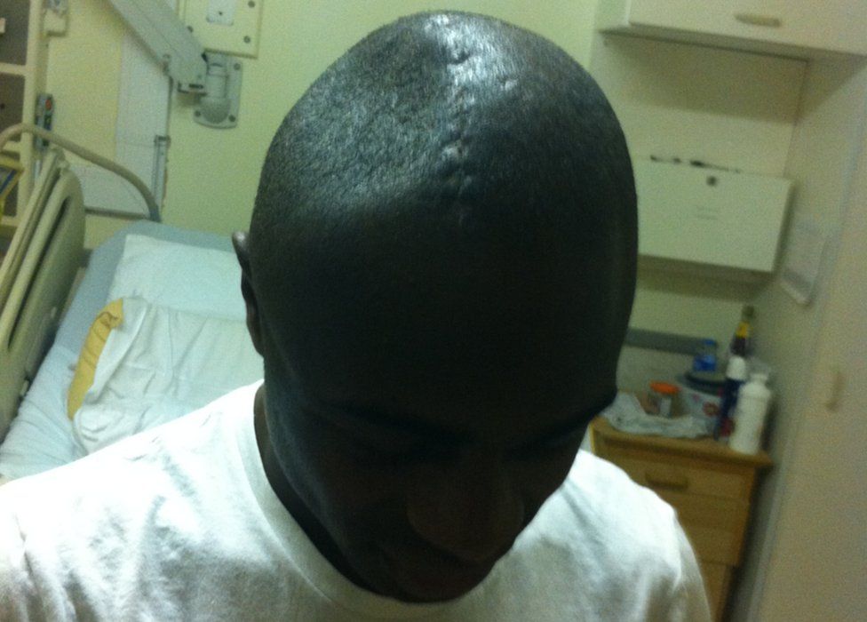 A scar on Jerome Wilson's head