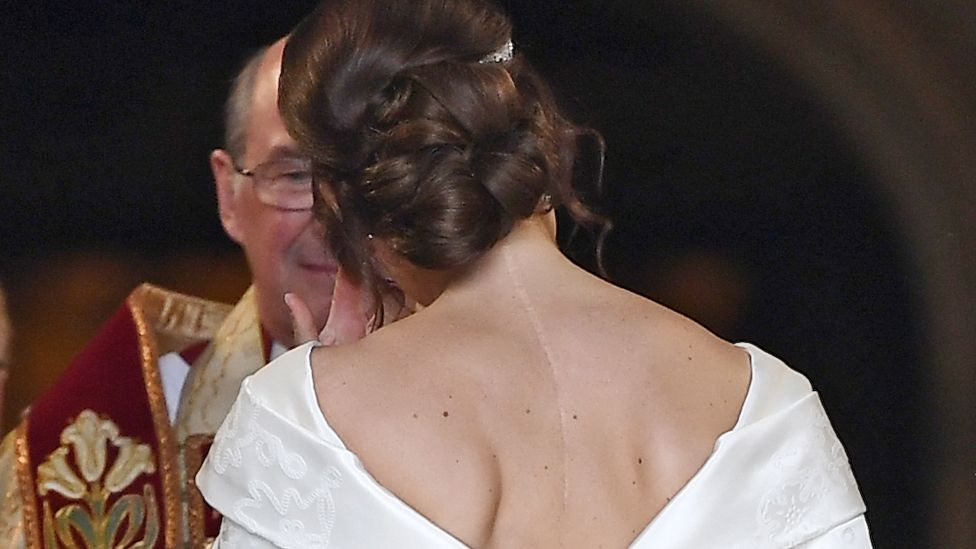 Princess Eugenie wedding Royal inspires others by showing scar