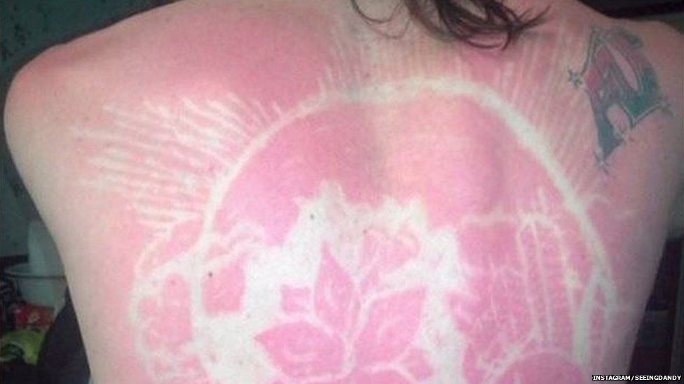 Trend for sunburn tattoos is incredibly dangerous and irresponsible   Metro News